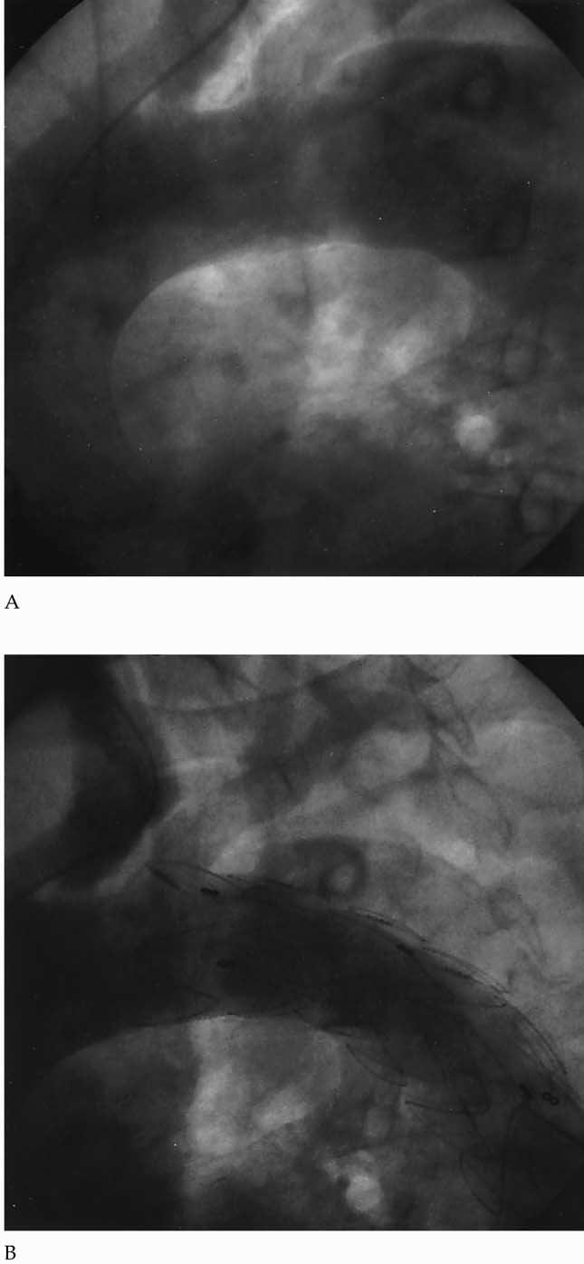 Ann Thorac Surg DUEBENER ET AL 2004;78:1261 7 EMERGENCY ENDOVASCULAR STENT-GRAFTING 1263 and on follow-up visits, imaging of the aorta was performed using computed tomography. Fig 1.