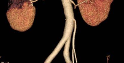 Atherosclerotic disease Renal artery embolism