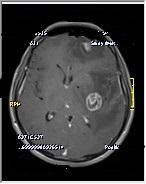 Spectroscopic MR imaging showed perfusion increase on the left hemisphere and choline peak. The patient was prediagnosed as glial tumor and metastasis.