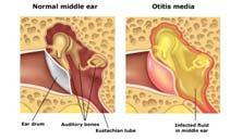 infection, genetics, vascular disease, head trauma Conductive hearing loss Sound traveling to the inner ear is blocked