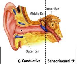 mass in the middle ear, stiffening of middle ear bones Mixed hearing loss A combination of sensorineural and conductive