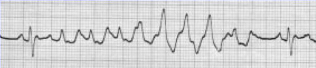 Spontaneous type 1 is a predictor of arrhythmic events in children 30 pts < 16 years 37 months f-up, 10%