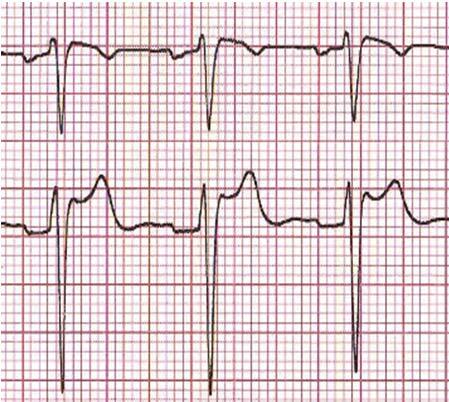 pt had persistent type 1 ECG at follow-up