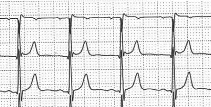 Type 1 Brugada pattern was 20 times more common in the