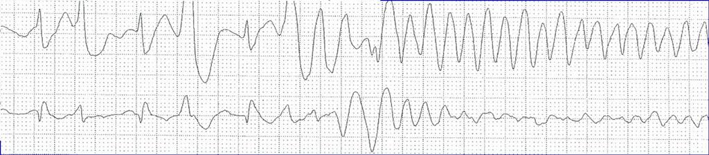 AF and Brugada ECG: which antiarrhythmic drug? Class IC drugs, amiodarone, Ca + - channel blockers are not indicated, as they can increase ST segment elevation and induce ventricular arrhythmias.