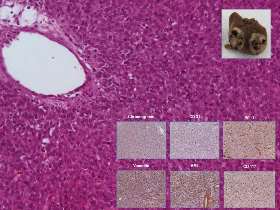 Figure 2 - Histological examination showing microscopic characteristics of juxtaglomerular tumor cells (Eosin and Hematoxylin): tumor cells with mild nuclear atypia, inconspicuous nucleoli and pale