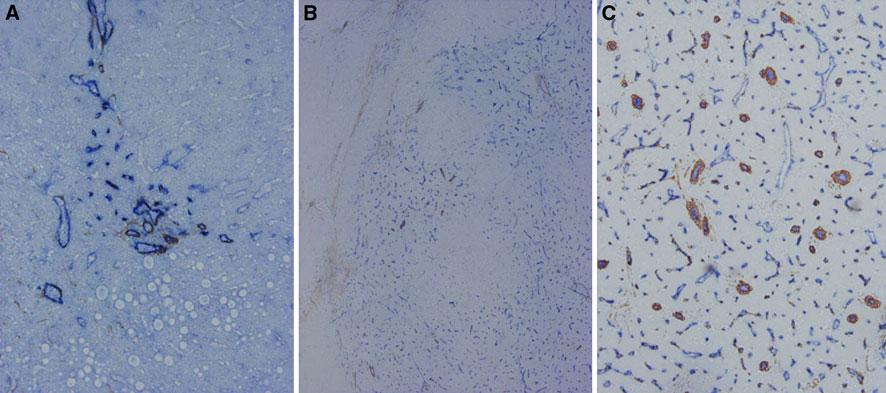 266 O. Matsui et al.: Hepatocelluar nodules in liver cirrhosis Fig. 1. Angiogenesis during multi-step.