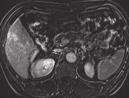 Pseudo Washout Sign on MRI of Hemangioma Fig. 2 (continued) 48-year-old man (patient 3) with chronic hepatitis C and hepatic hemangioma in segment V, confirmed by follow-up gadobutrol-enhanced MRI.