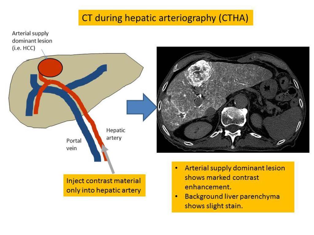 Fig. 5: CT during hepatic arteriography (CTHA) References: Radiology - Kanazawa/JP The intranodular blood supply evaluated by
