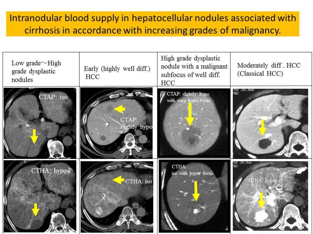 Fig. 7: Intranodular blood supply in hepatocellular nodules associated with cirrhosis in accordance with increasing grades of malignancy.