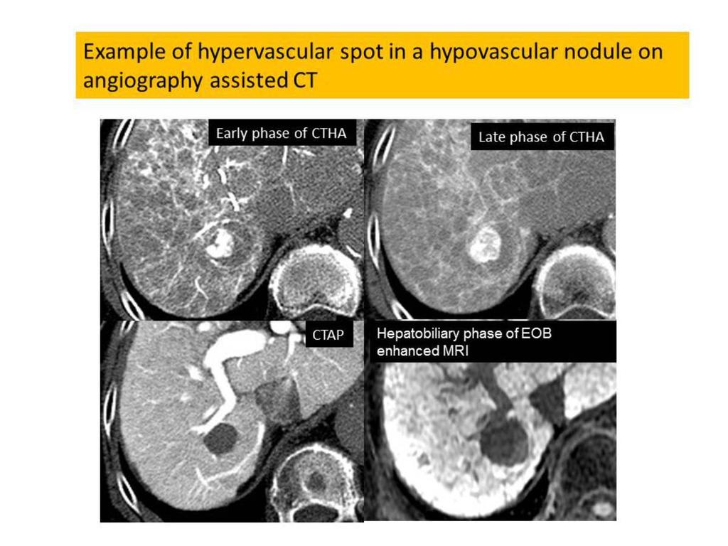 Fig. 9: Example of hypervascular spot in a hypovascular nodule on angiography assisted CT.