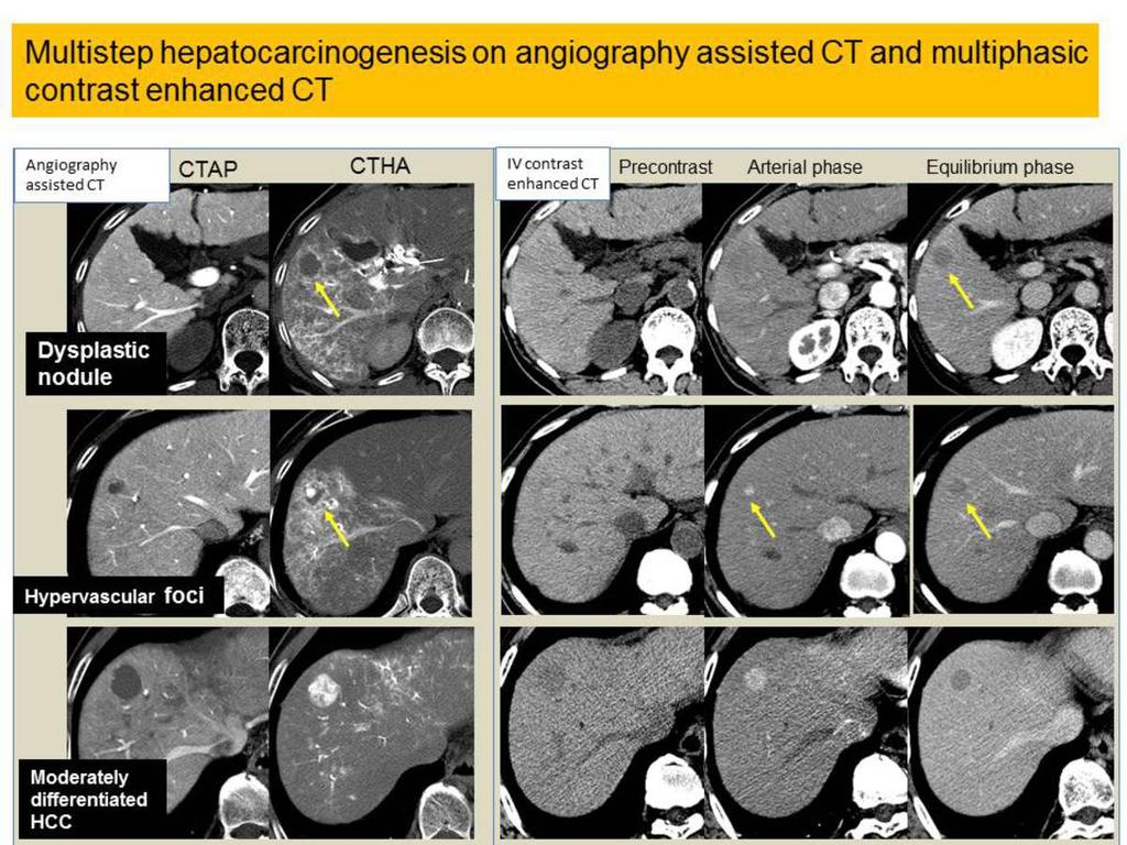 Fig. 11: Multistep hepatocarcinogenesis on angiography assisted CT and multiphasic contrast enhanced CT.