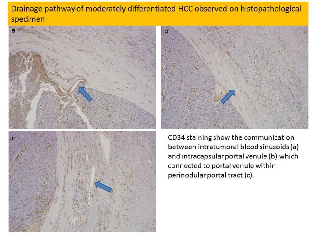 Fig. 13: Drainage pathway of moderately differentiated HCC observed on histopathological specimen.