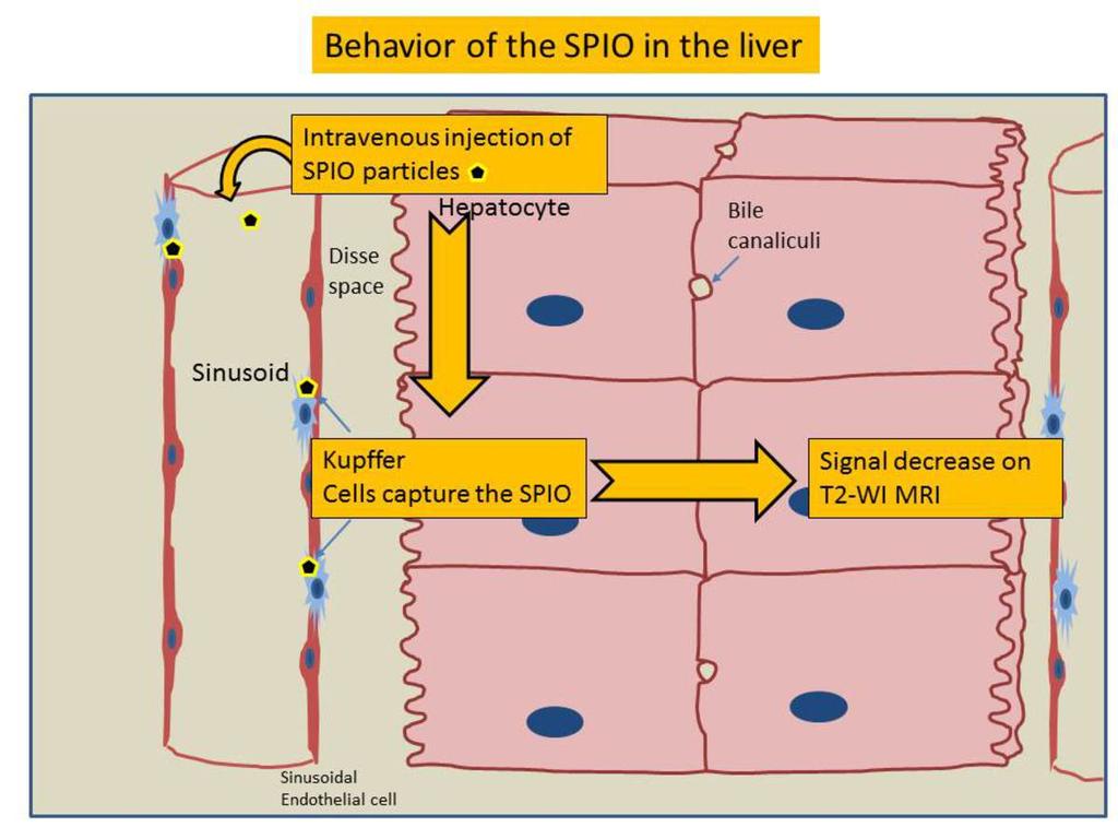 Fig. 19: Behavior of the SPIO in the liver. References: Radiology - Kanazawa/JP Imai et al.