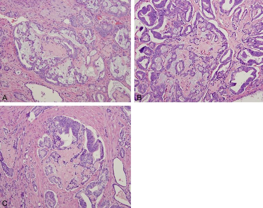 Figure 2. Collagenous micronodules present as single/focal (A and B) or multiple/aggregated forms (C and D) and found in the immediate vicinity of malignant prostate cancer glands.
