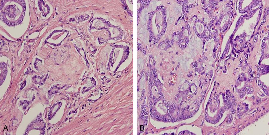 Figure 4. Occasionally, these stromal nodules in grade 4 areas showed pseudo-grade 3 pattern resulting from collagen impinge on malignant glands (A and B). Hematoxylin and eosin stain 200. Figure 5.