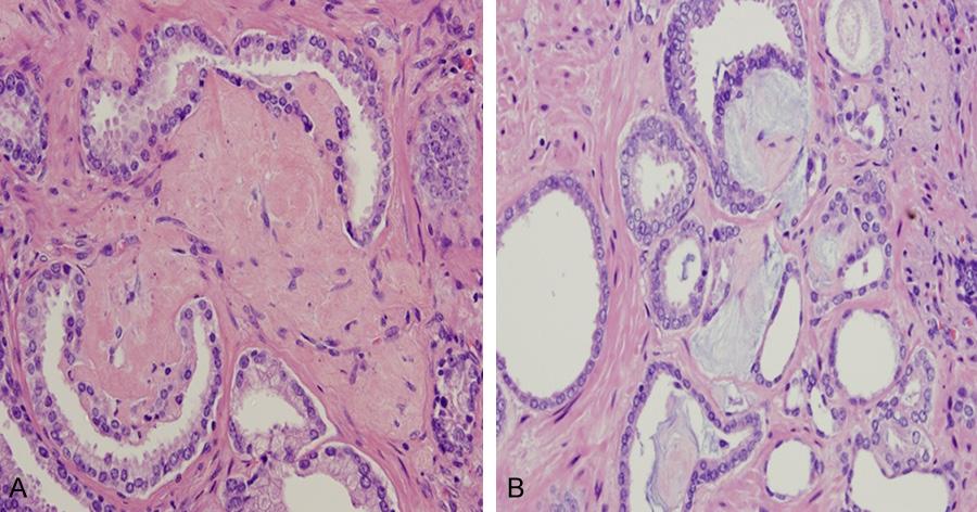 (41%) (Figure 7), amphophilic luminal secretions in 89 cases (69%) and circumferential perineural invasion in 93 cases (72%) of prostatic adenocarcinoma (Figure 8).