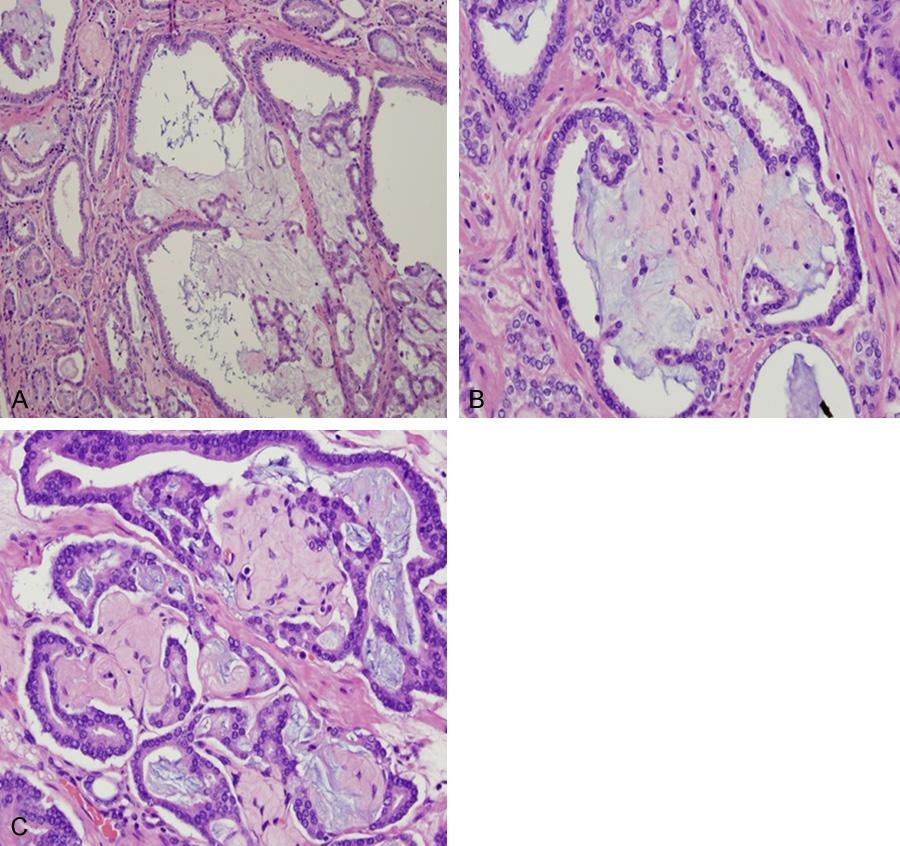 Figure 8. Circumferential perineural invasion identified in foci of prostatic adenocarcinoma with collagenous micronodules. Hematoxylin and eosin stain 200. Figure 6.