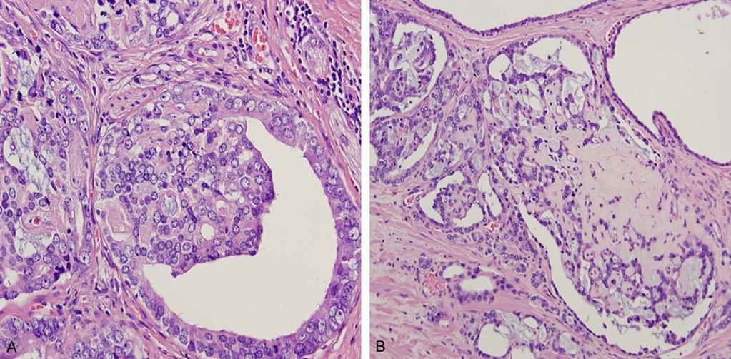 ation between mucin producing tumor glands and CMs has also been reported by several authors [9, 13-15].