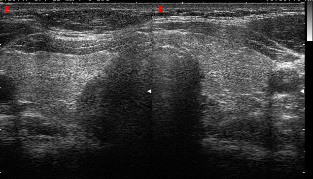 Lipoma overlying strap muscle?