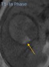 Outline : Imaging Jewels Jewels of hepatobiliary cancer imaging : what to look for?