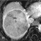 liver MRI, springer 2005 Evolution of