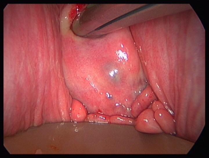 Deep disease in the Posterior cul de sac The lesion is