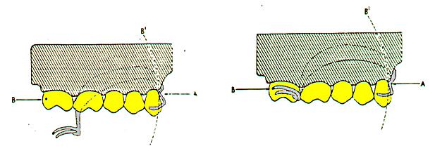 Figure 2 - a) setting of the rotational centers; b) final setting by rotation of the prosthesis.