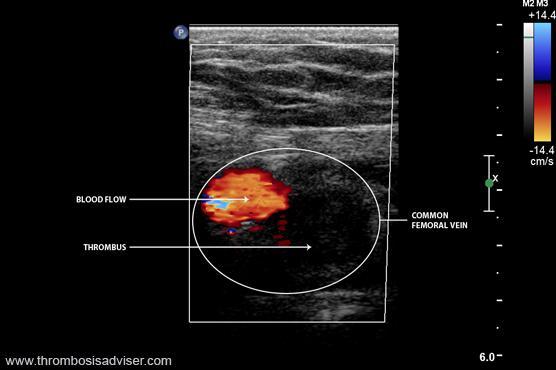 Imaging Doppler: occlusive thrombus in the common