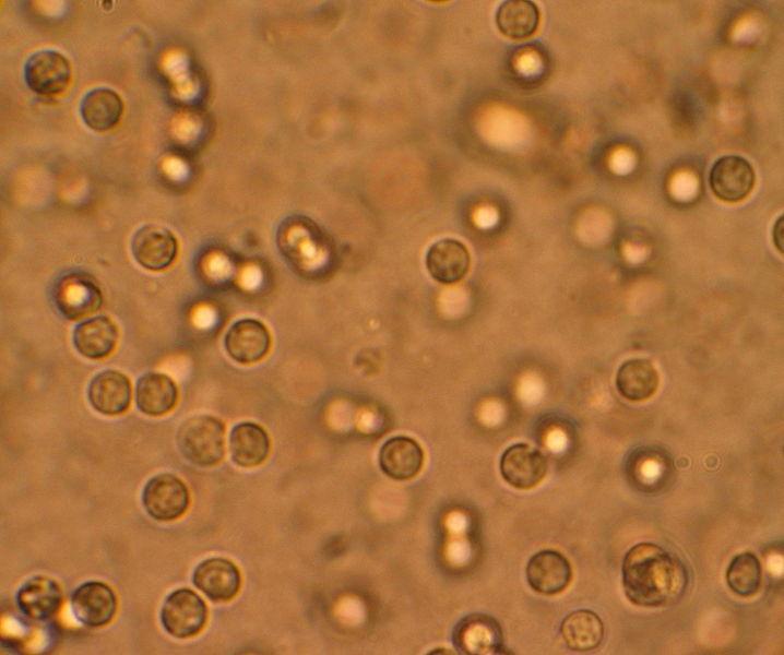 Pus cells in urine