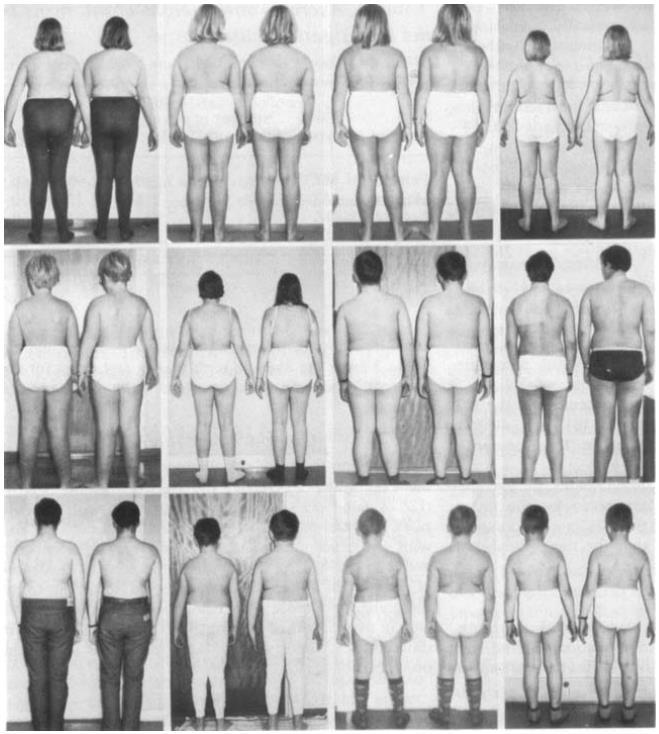 HUMAN BODY WEIGHT HAS A STRONG GENETIC BASIS Identical twin pairs