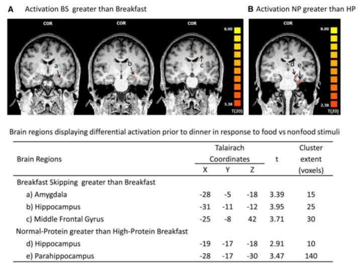 Brain activation contrast maps before dinner after the breakfast skipping (BS), normal protein (NP), and high protein (HP) testing days in 20 adolescent girls Repeated-measures ANOVA examining the