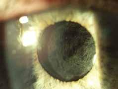 Large, well conducted observational studies consistently provide evidence for the 54 clinical effectiveness of cataract extraction in routine practice, and demonstrable improvement in reported