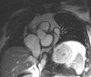 LVOT Left ventricular outflow