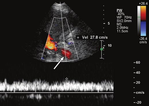 Sonography of Portal Vein Stenosis ultrasound examinations in the early postoperative period without evidence of subsequent graft dysfunction [7].