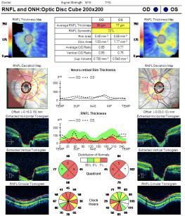 OCT retinal layer Segmentation Errors Irregular OCT scan signal pattern can lead to