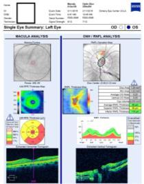 Posterior vitreous detachment (PVD) can interfere with OCT RNFL