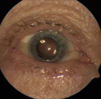 quality Look at the sharpness of the corneal reflex to evaluate corneal surface Ensure accurate