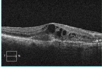 swelling of retina ) Before repair After