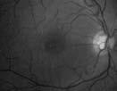 Degenerative Disease Stages of AMD Macula and