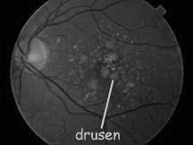 drusen, focal RPE hyperpigmentation
