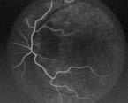 Suspect CNVM: FA within 72 hrs** Stages Choroidal phase (10 sec