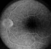 Laminar venous phase (14-20 sec) Dye begins to fill retinal vein