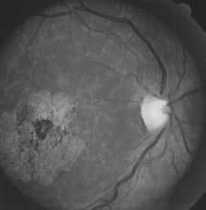 risk for advanced AMD AMD has a genetic component but the disease is multifactorial Environmental, dietary,