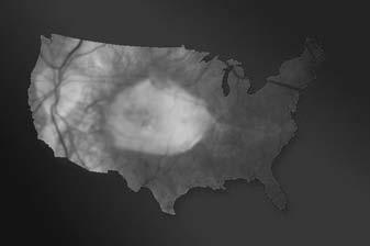 AMD cases in USA rose 25% from 2002 to present Vision Problems in the U.S. Study www.preventblindness.org Beaver Dam Eye Study 5 yr.