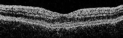 Cell Layer RPE: Retinal Pigment Epithelium CC: