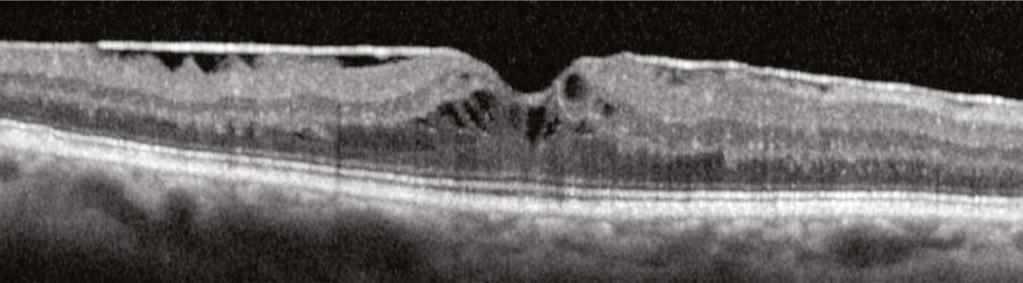 Epiretinal Membrane ERM: Retinal Distortion Below, in the OCT image of a patient complaining of visual distortions