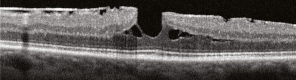 Sometimes it is difficult to distinguish ERM from RNFL in the OCT image, but clinical correlation is often useful in