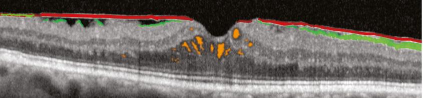 In this section adjacent to the fovea (represented by the central green line in the fundus photograph to the bottom