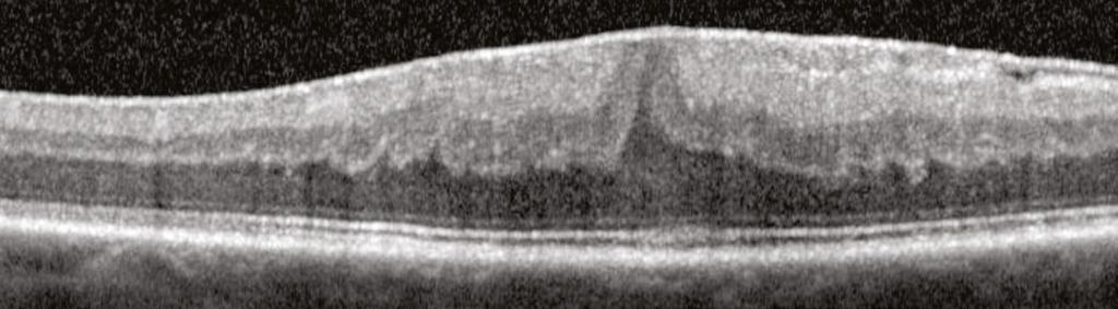 edema. There are intraretinal cysts (shaded orange) within the outer nuclear layer and within the inner nuclear layer.